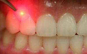 استفاده از لیزر در دندان پزشکی