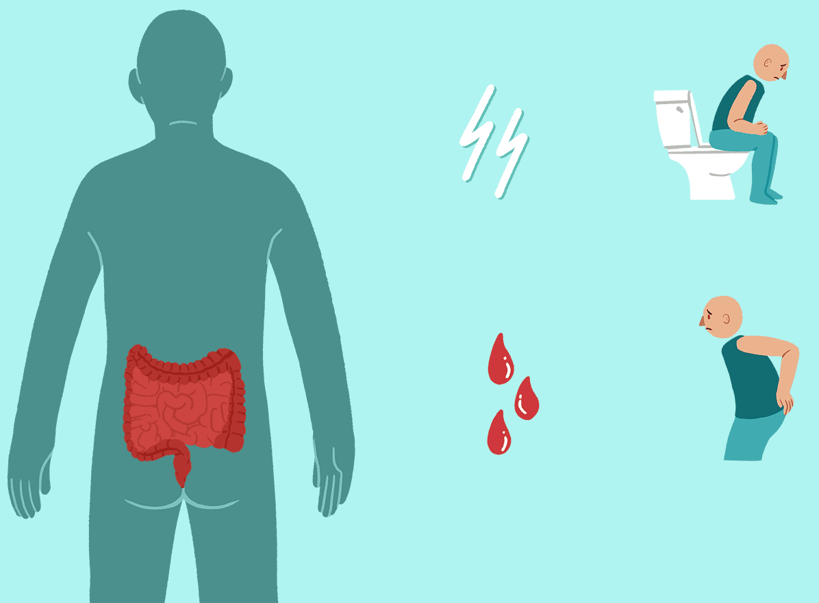 after-hemorrhoid