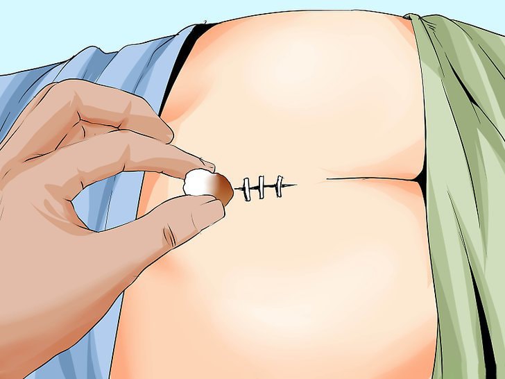 v4-728px-Treat-a-Pilonidal-Cyst-Step-3-min v4-728px-Treat-a-Pilonidal-Cyst-Step-3-min