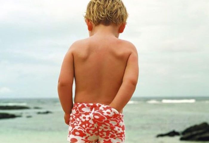 تبخال مقعدی در کودکان + علت و علائم و درمان + عکس